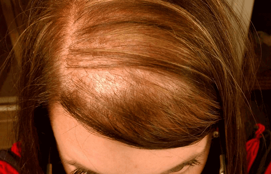 a alopecia androgenética, como o nome sugere, é um fator genético hereditário da calvicie