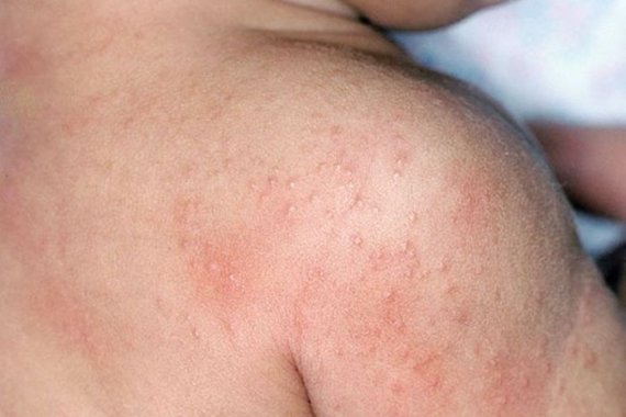 Brotoeja em bebê: 5 dicas para tratar e evitar esta dermatite